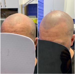 Scalp enhancement bc before and after 1