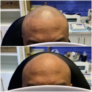 Scalp enhancement bc before and after 1
